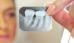 Best Root Canal Treatment Specialist in San Ramon, CA